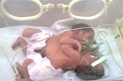 Cặp song sinh dính liền ở Hà Giang tiên lượng xấu