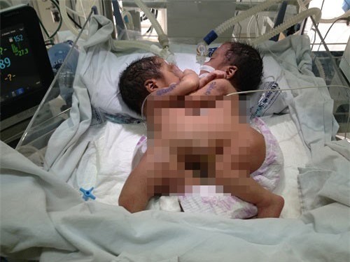 Xót thương cặp song sinh dính liền ở Hà Giang qua đời do bệnh nặng