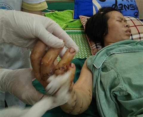 Kinh hoàng vợ bị chồng chém gần đứt lìa bàn tay