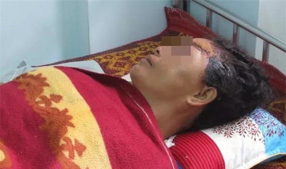 Phẫn nộ nghịch tử cầm đòn gánh đánh mẹ gãy xương trán