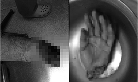 Nam thanh niên bị máy cưa gỗ cưa đứt lìa cổ tay trái