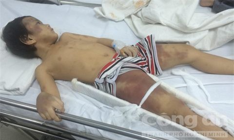 Phẫn nộ cha dượng, mẹ đẻ đánh gẫy chân bé trai 5 tuổi