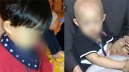 Uống "thảo dược" 1 tuần bé 2 tuổi không còn một sợi tóc