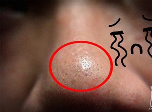 Đánh bay mụn đầu đen với hỗn hợp tự chế cực đơn giản