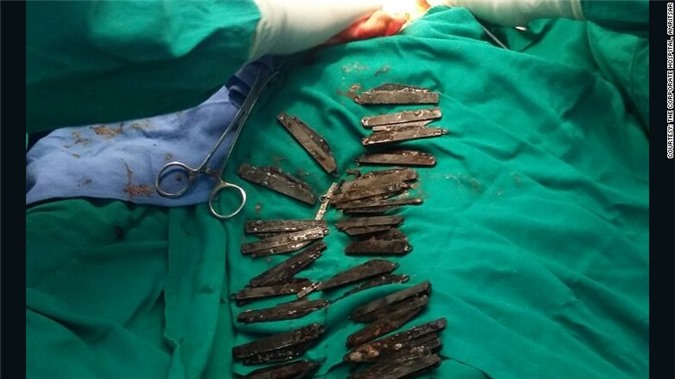 Ấn Độ: Bác sĩ moi được 40 con dao từ bụng bệnh nhân