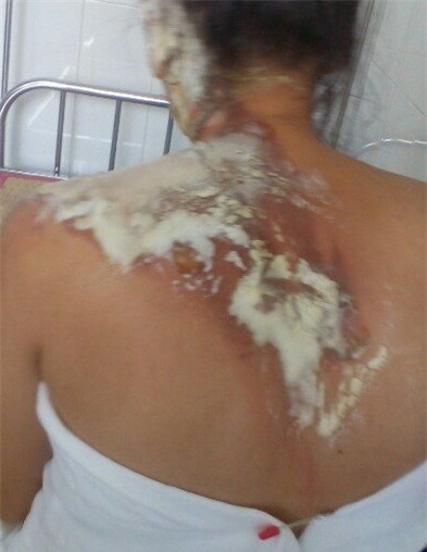 Chồng dội nước sôi vào tai vợ: Công an vào cuộc điều tra