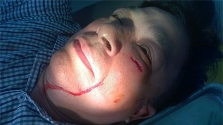 Giám đốc công ty gas bị côn đồ đập gạch rách mặt