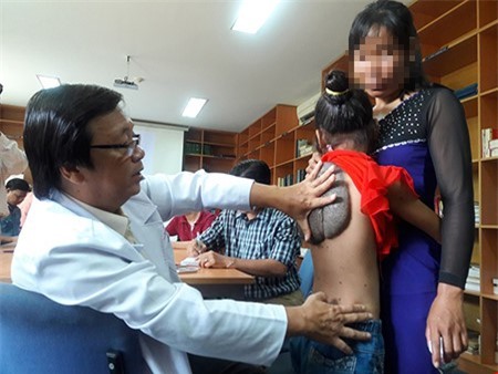 Kỳ lạ bé gái mọc “mai rùa” trên lưng chưa từng có ở Việt Nam