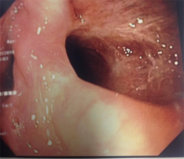 Bé gái 6 tuổi thủng thực quản vì nuốt phải đồ chơi