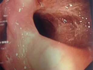Bé gái 6 tuổi thủng thực quản vì nuốt phải đồ chơi