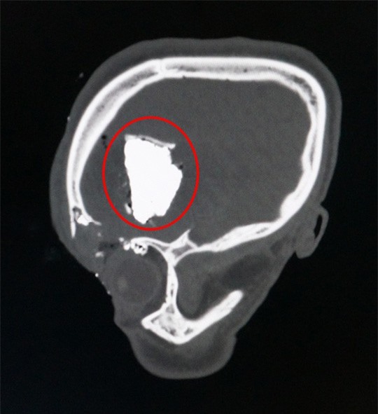 Cứu sống một thanh niên bị lưỡi cưa ghim vào hộp sọ ngất xỉu