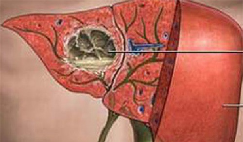 Những dấu hiệu phát hiện tiền ung thư gan