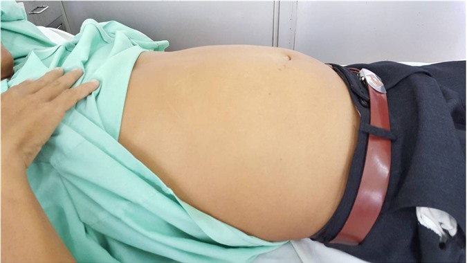 Sốc: Bác sĩ mổ lấy khối bướu "khủng" trong bụng người đàn ông