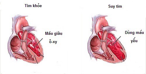 Dấu hiệu cho thấy bạn đang có nguy cơ mắc bệnh suy tim