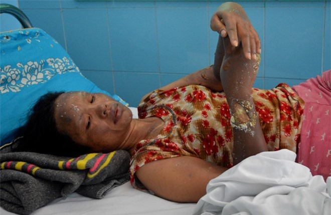 Nổ bóng bay đêm trung thu: Nạn nhân đã qua cơn nguy kịch