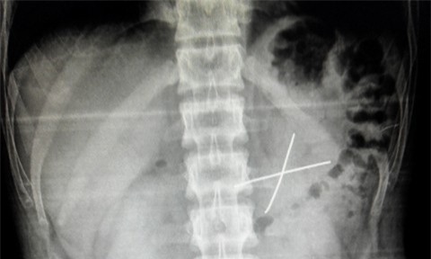 Nam thanh niên xăm trổ suýt chết vì nuốt 2 dây kẽm vào bụng