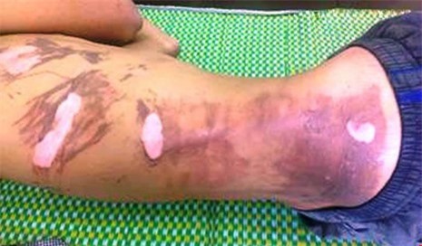 Ngậm xăng phun lửa khi múa lân, một thanh niên bị bỏng nặng