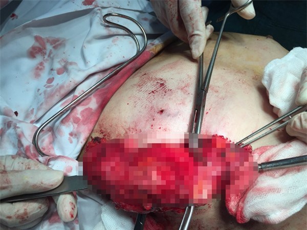 Kinh hãi người phụ nữ phải cắt tuyến vú vì nâng ngực 