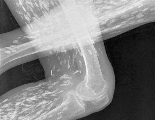 Ăn tiết canh, cụ bà 69 tuổi bị sán dây "dạo chơi" khắp người