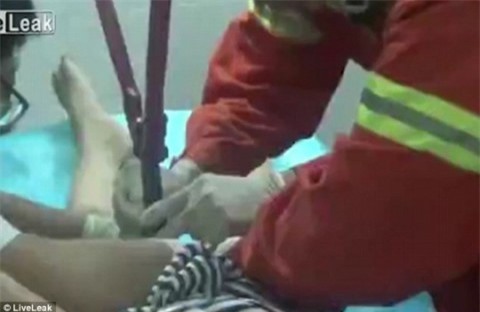 Nam thanh niên nghịch dại làm mắc kẹt nhẫn vào "của quý"