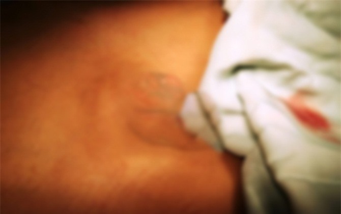 Bé trai 8 tuổi bị đứt lìa dương vật được nối thành công