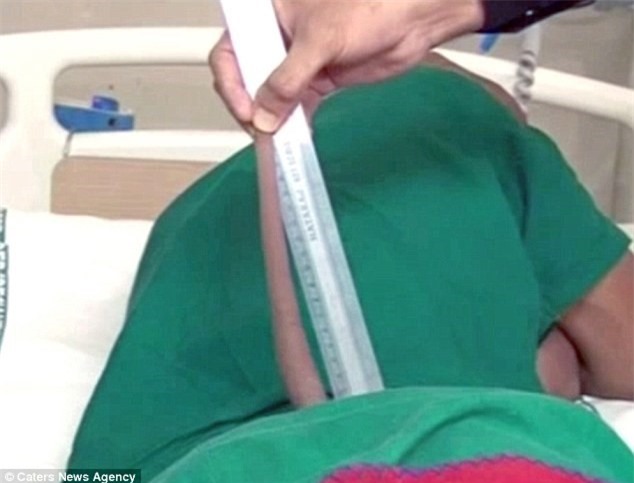 Sốc: Thanh niên mọc đuôi dài gần 18 cm hiếm gặp 