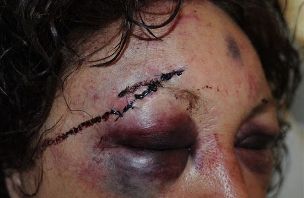 Kẻ hiếp dâm sa lưới vì bị nạn nhân dùng máu đánh dấu