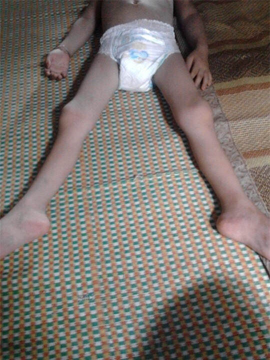 Hòa Bình: Bệnh nhân bị liệt hai chân sau khi mổ viêm ruột thừa? 