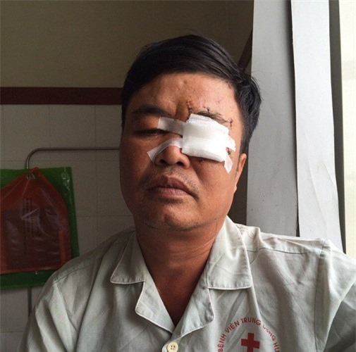 Bị đánh hỏng mắt vì xin hát 1 bài sau đám giỗ