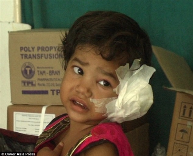 Kinh hoàng phát hiện 80 con ấu trùng trong tai của bé gái 4 tuổi