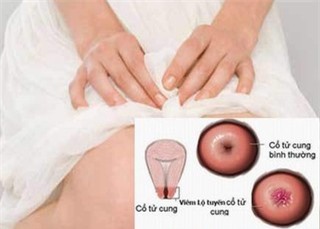 Những điều cần biết về viêm lộ tuyến cổ tử cung