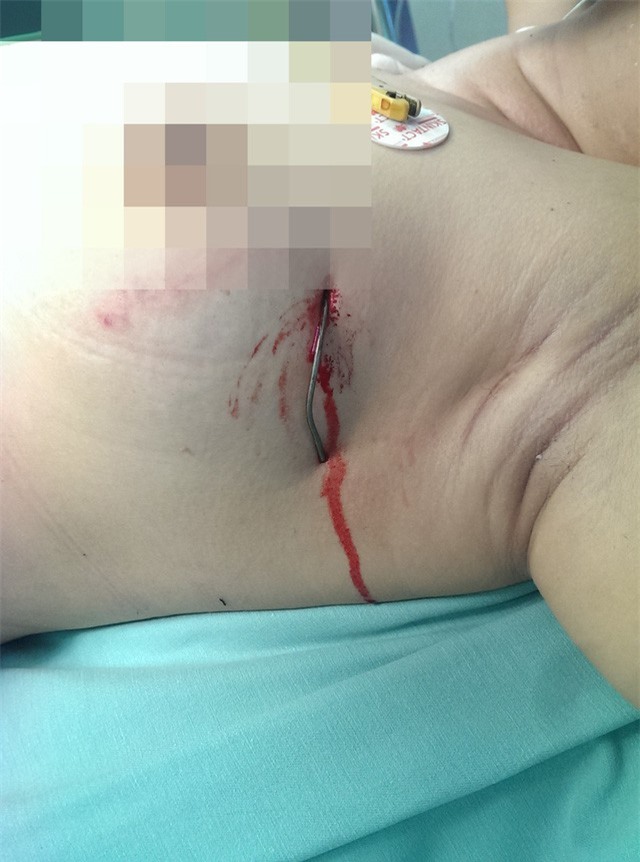 Hà Nội: Người phụ nữ bị kim loại cắm vào ngực sâu 15cm 