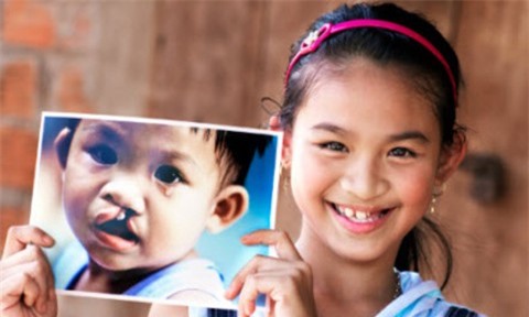 Phẫu thuật miễn phí cho trẻ em bị hở môi hàm ếch