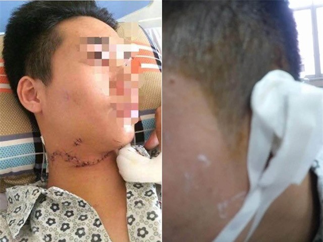 Kinh hoàng học sinh ngã xe bị tôn cứa cổ, đứt tai ở Hà Nội