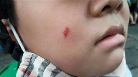 Vụ cô giáo làm xước má học sinh, mẹ bị phạt 7 triệu đồng