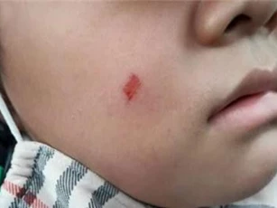 Vụ cô giáo làm xước má học sinh, mẹ bị phạt 7 triệu đồng