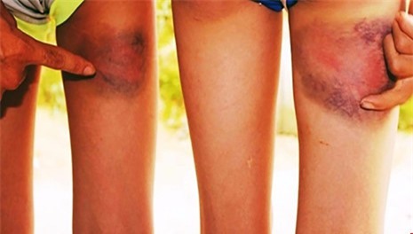 Giáo viên giỏi cấp tỉnh đánh bầm tím đùi học sinh