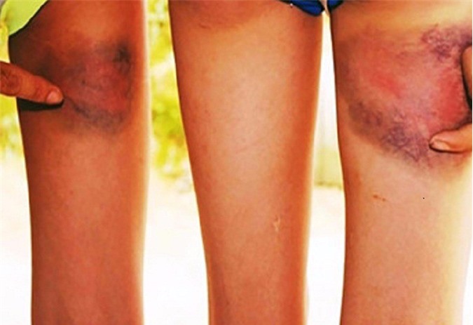 Thầy giáo đánh học sinh tím đùi: Giám đốc Sở GD&ĐT vào cuộc điều tra