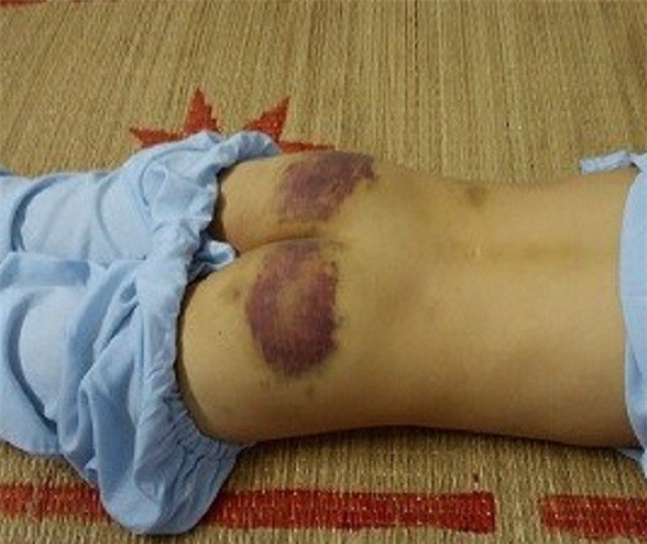 Xót xa bé trai 12 tuổi bị mẹ kế dùng chày đánh bầm tím người