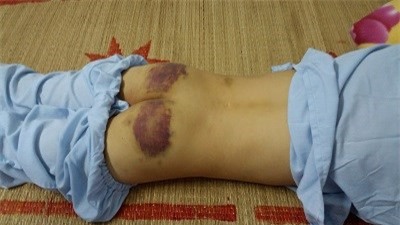 Bé trai 12 tuổi bị mẹ kế dùng chày đánh bầm dập