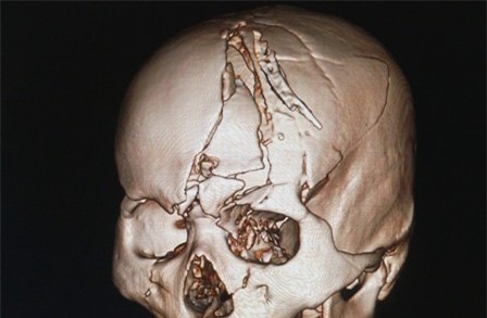 Nam thanh niên vỡ nát nhiều mảnh sọ sau tai nạn giao thông