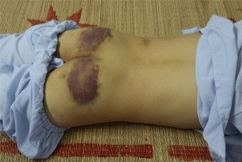 Tình tiết mới nhất vụ bé trai 12 tuổi bị mẹ kế bạo hành