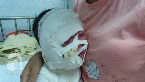 Mẹ trẻ phát hoảng vì con trai bị ấm siêu tốc đổ xuống đầu 