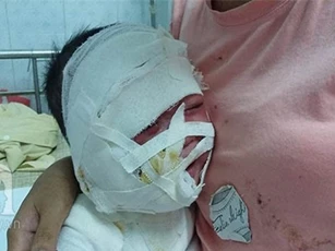 Mẹ trẻ phát hoảng vì con trai bị ấm siêu tốc đổ xuống đầu