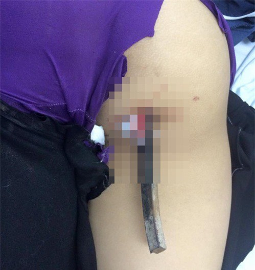 Kinh hoàng: Nữ sinh 16 tuổi bị thanh sắt đâm xuyên người