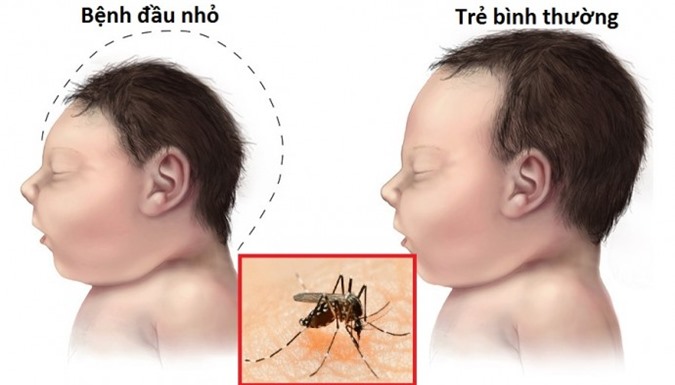Virus Zika có thể làm teo tinh hoàn, vô sinh ở nam giới