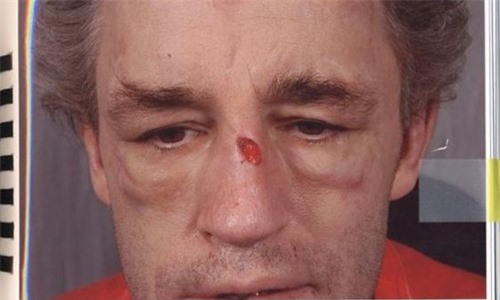 Từ chối quan hệ, người đàn ông bị bạn gái đánh đập dã man