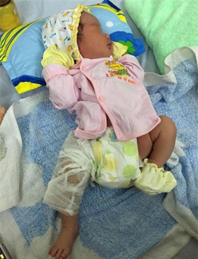 Đã có thông báo chính thức vụ làm gãy xương đùi trẻ sơ sinh