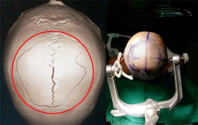 Đụng đầu vào trần nhà, người đàn ông bị nứt sọ não 