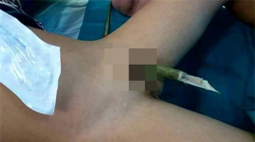 Bé trai 9 tuổi bị cành nhãn đâm xuyên "của quý"